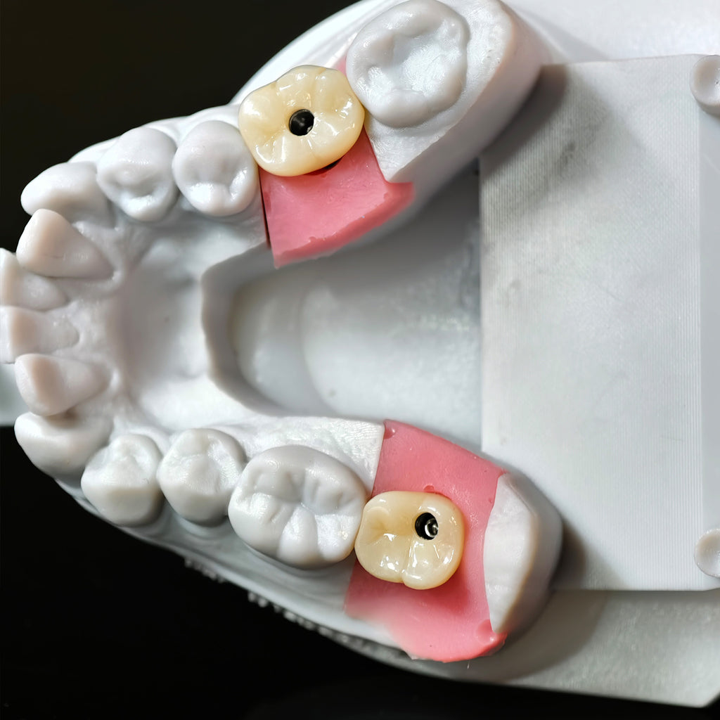 Zirconia Crowns With Screw Retained