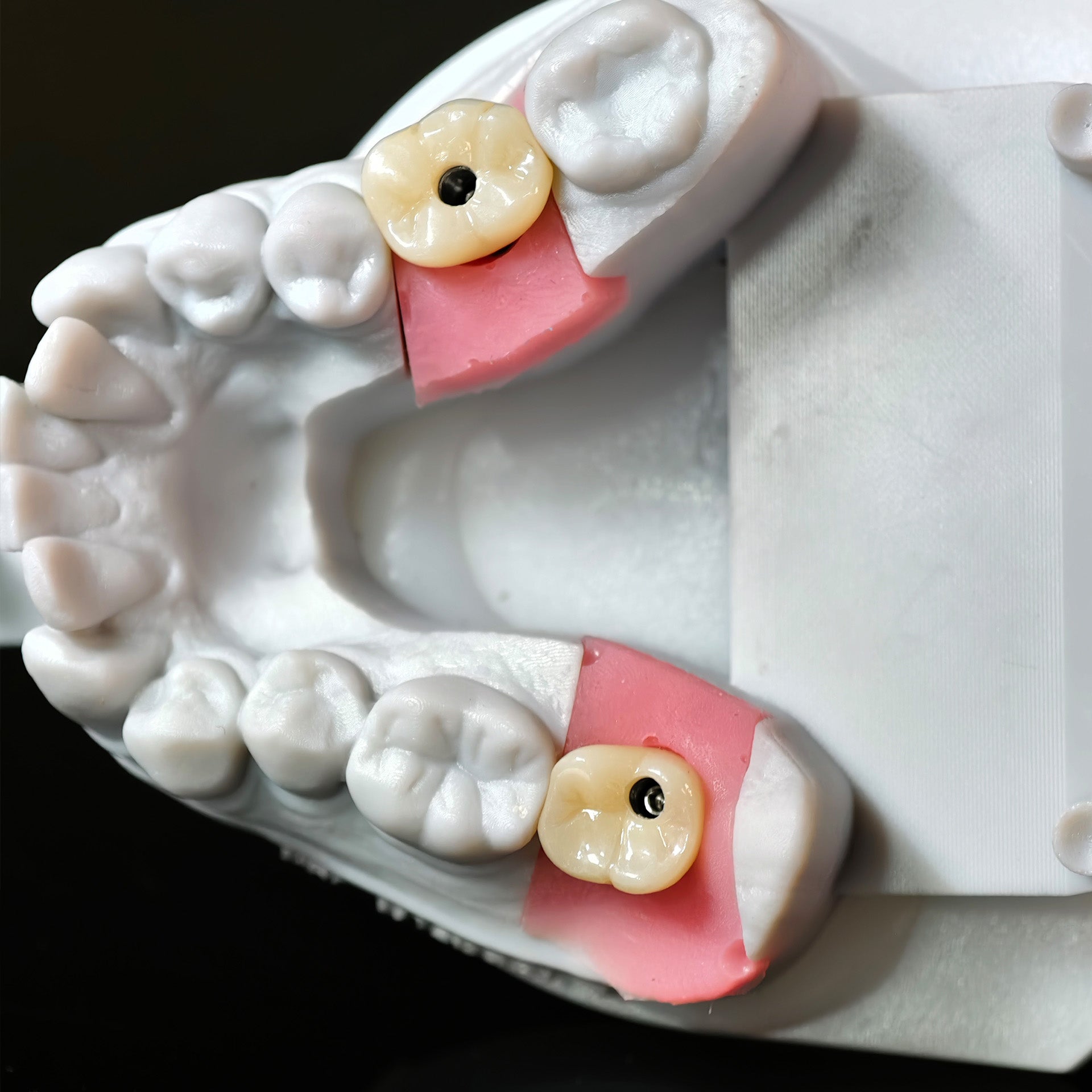 Zirconia Crowns With Screw Retained