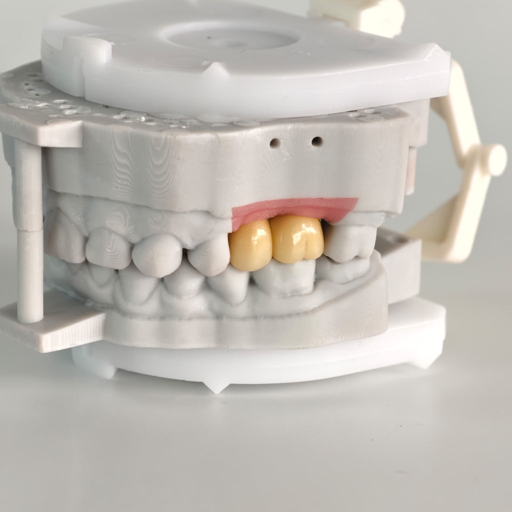 Zirconia Crowns With Screw Retained And Gold-Plated Custom Abutment