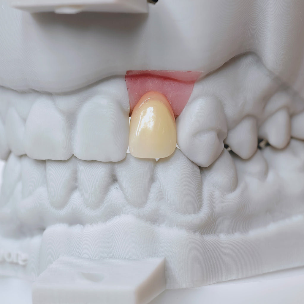 Zirconia Crown With Screw Retained
