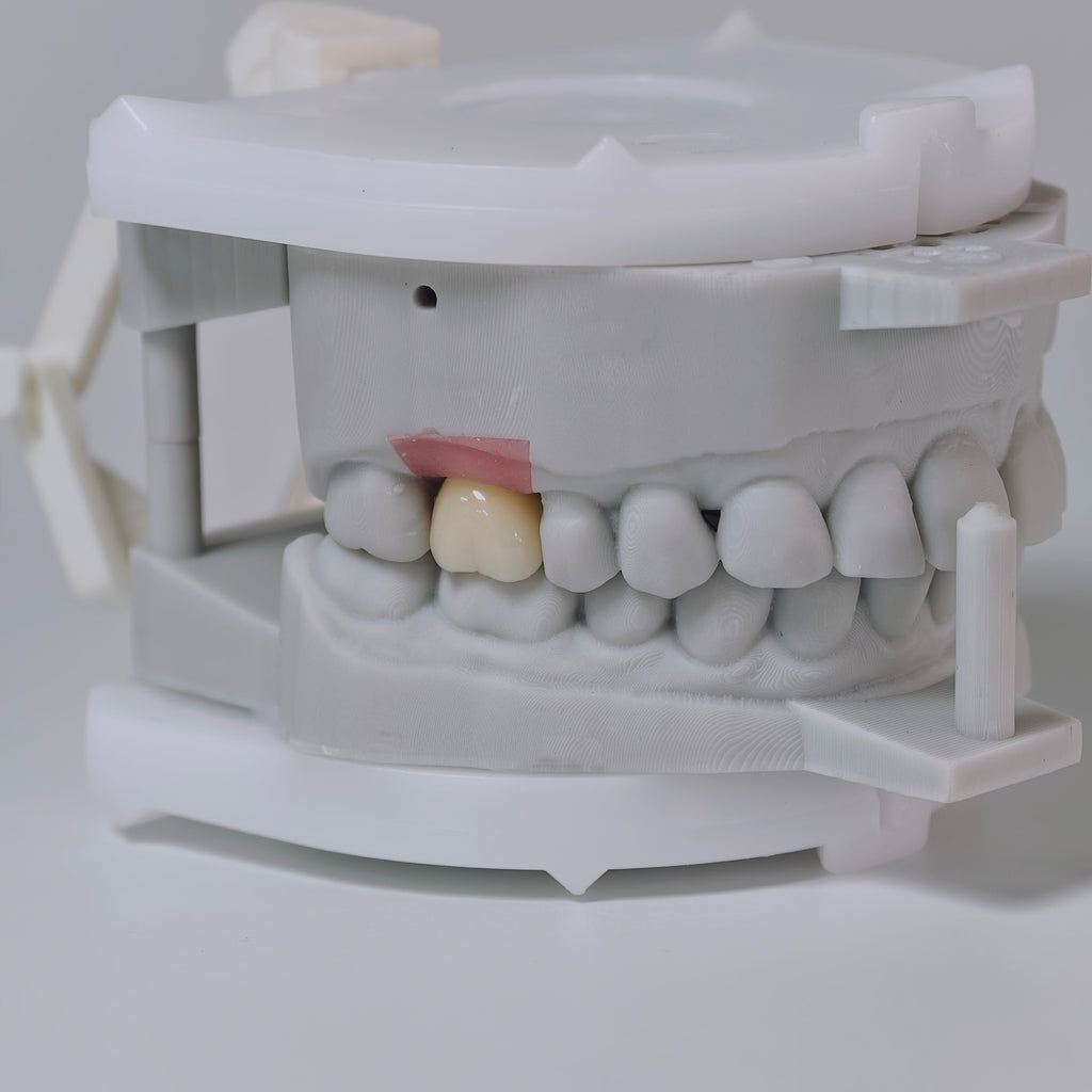 Zirconia Crown With Screw Retained