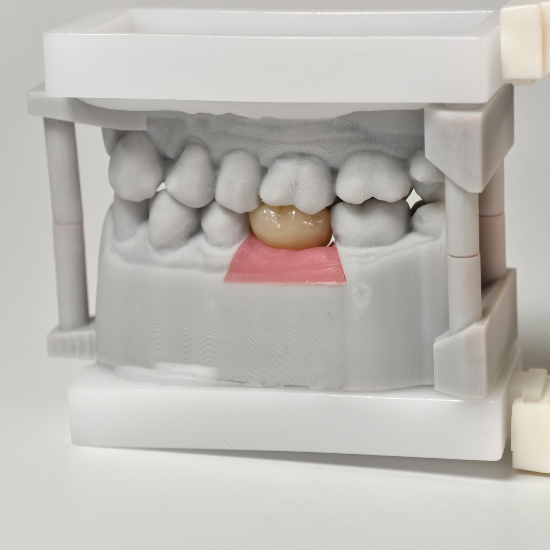 Zirconia Crown With Screw Retained