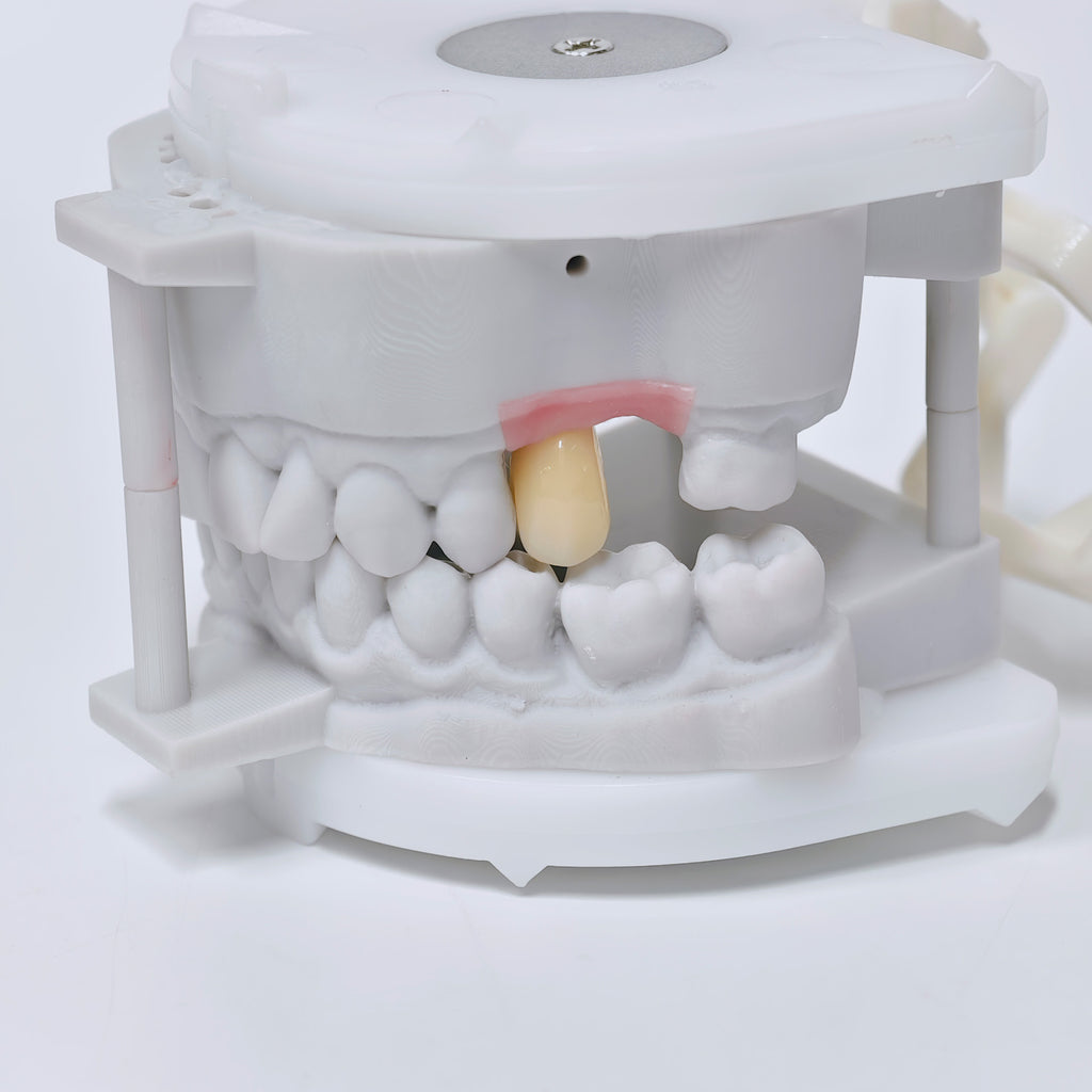 Zirconia Crown With Screw Retained