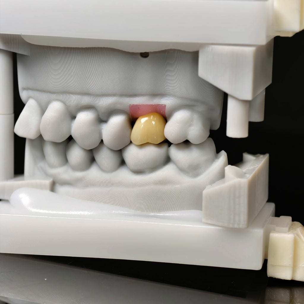 Zirconia Crown With Screw Retained