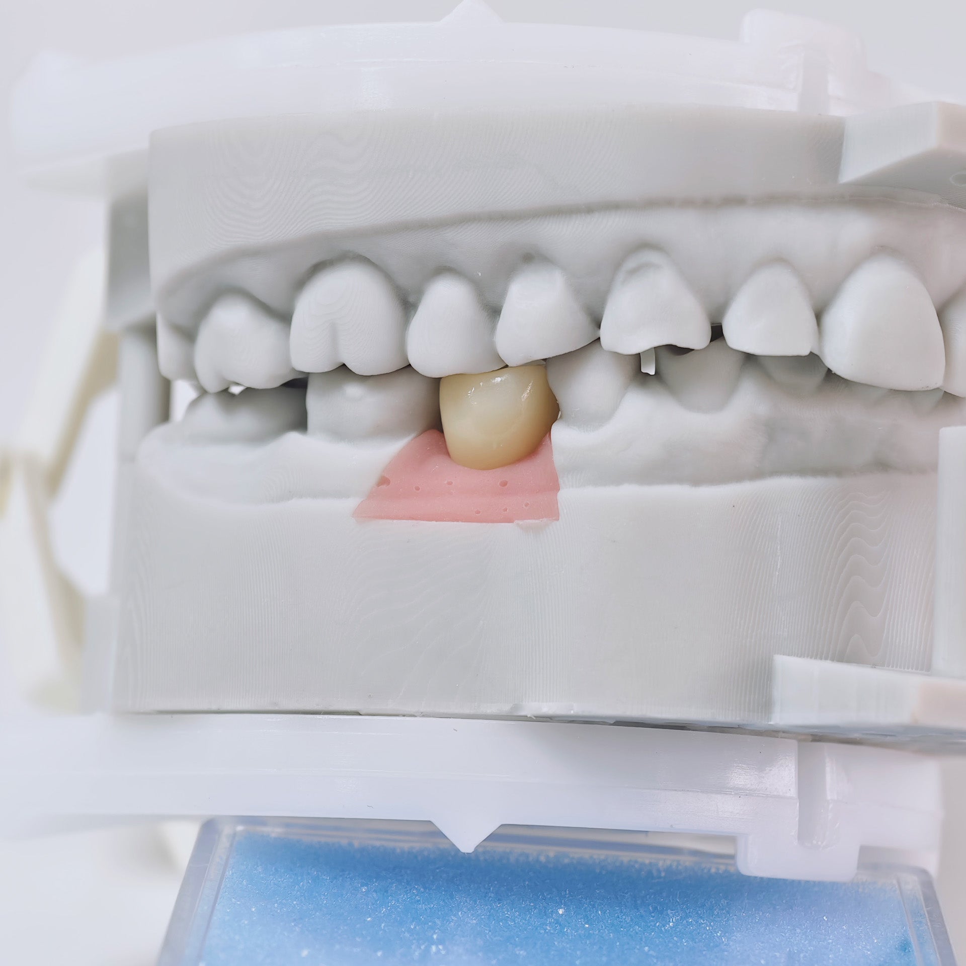 Zirconia Crown With Screw Retained