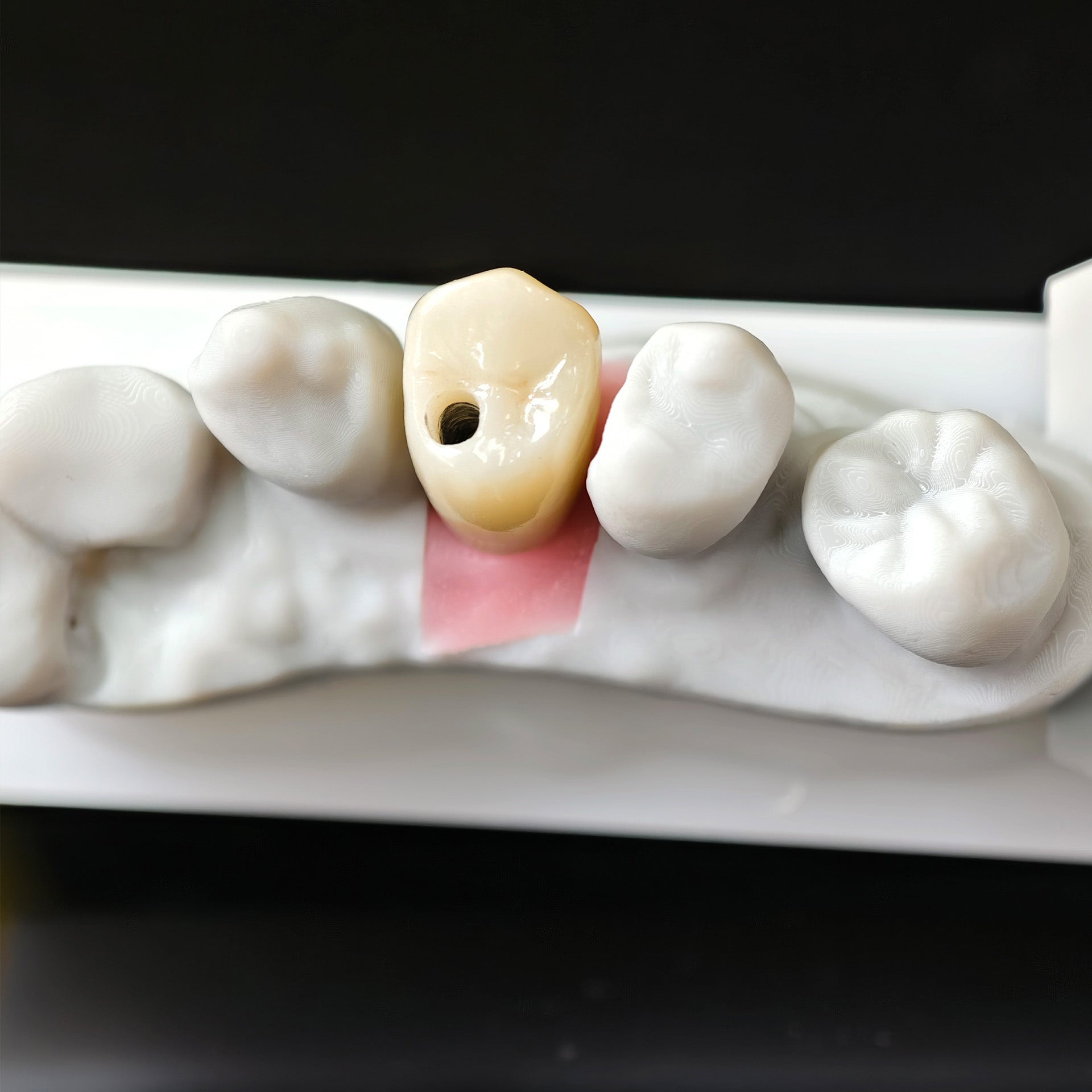 Zirconia Crown With Screw Retained