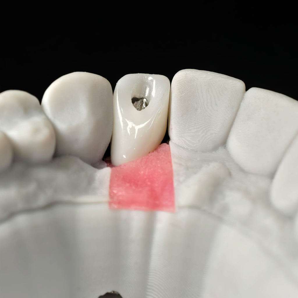 Zirconia Crown With Screw Retained