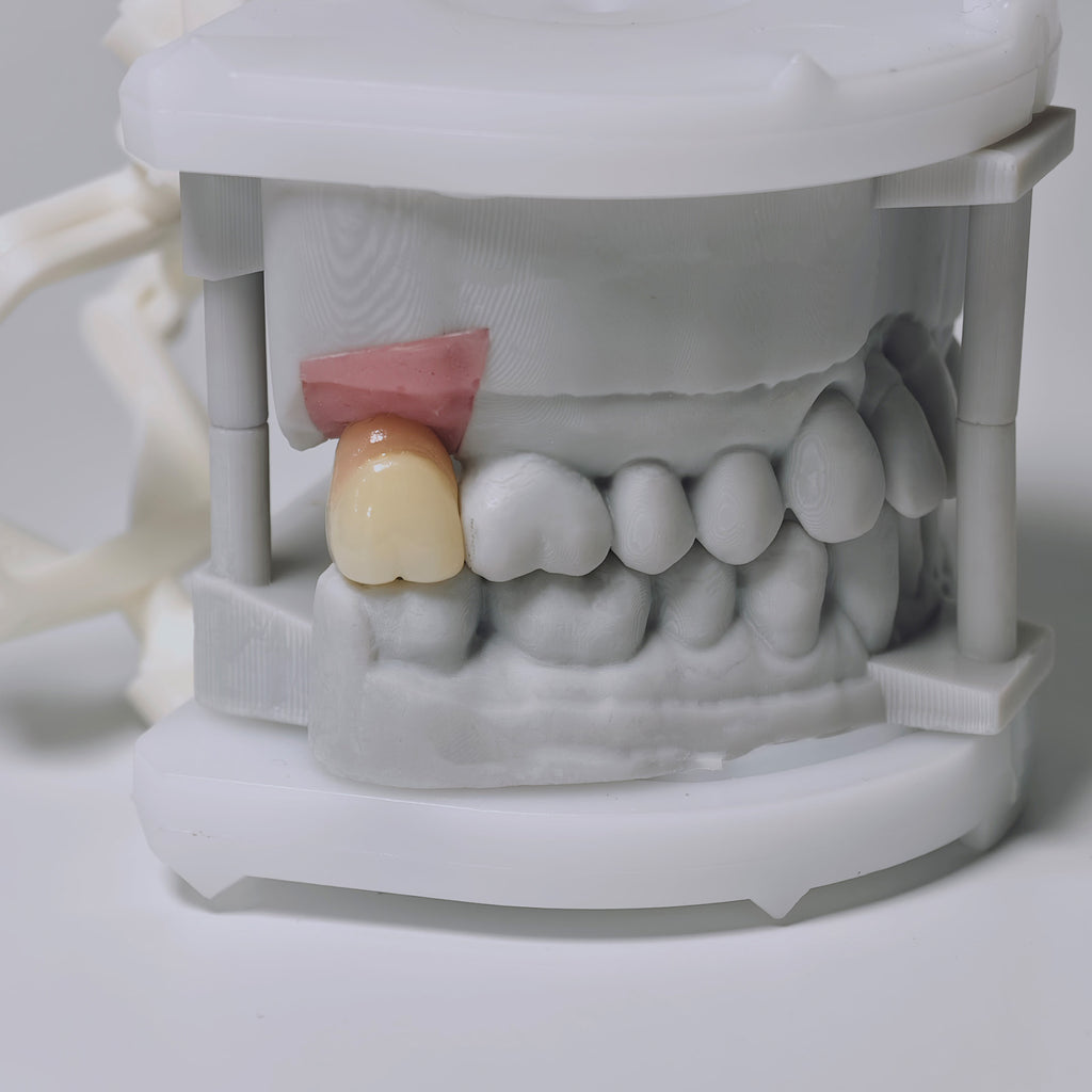 Zirconia Crown With Screw Retained