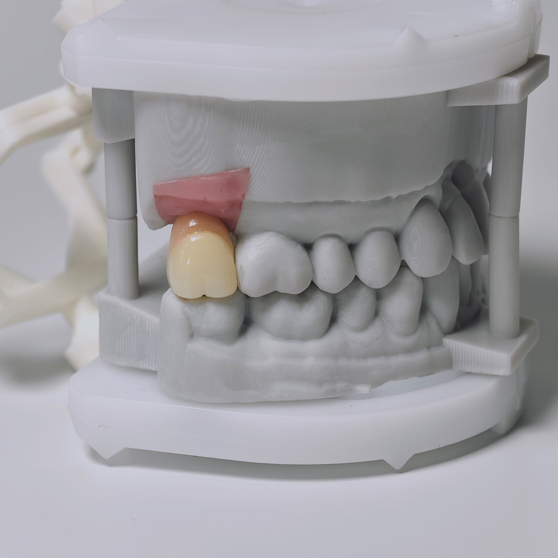 Zirconia Crown With Screw Retained