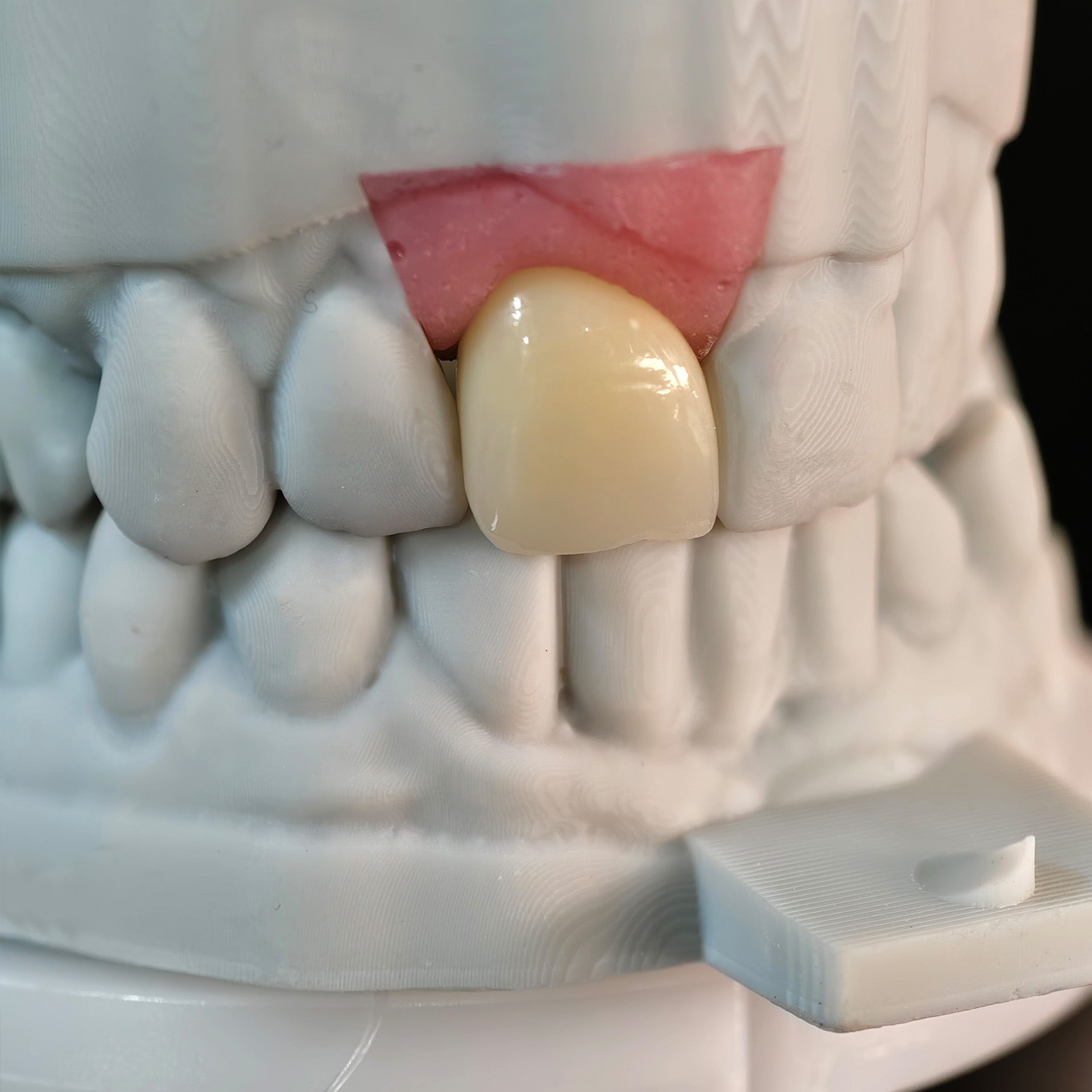 Zirconia Crown With Screw Retained