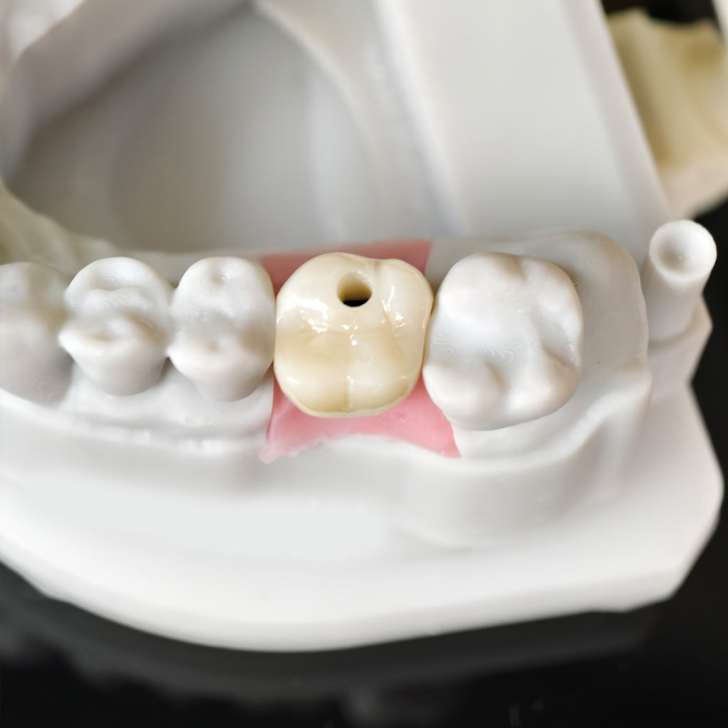 Zirconia Crown With Screw Retained
