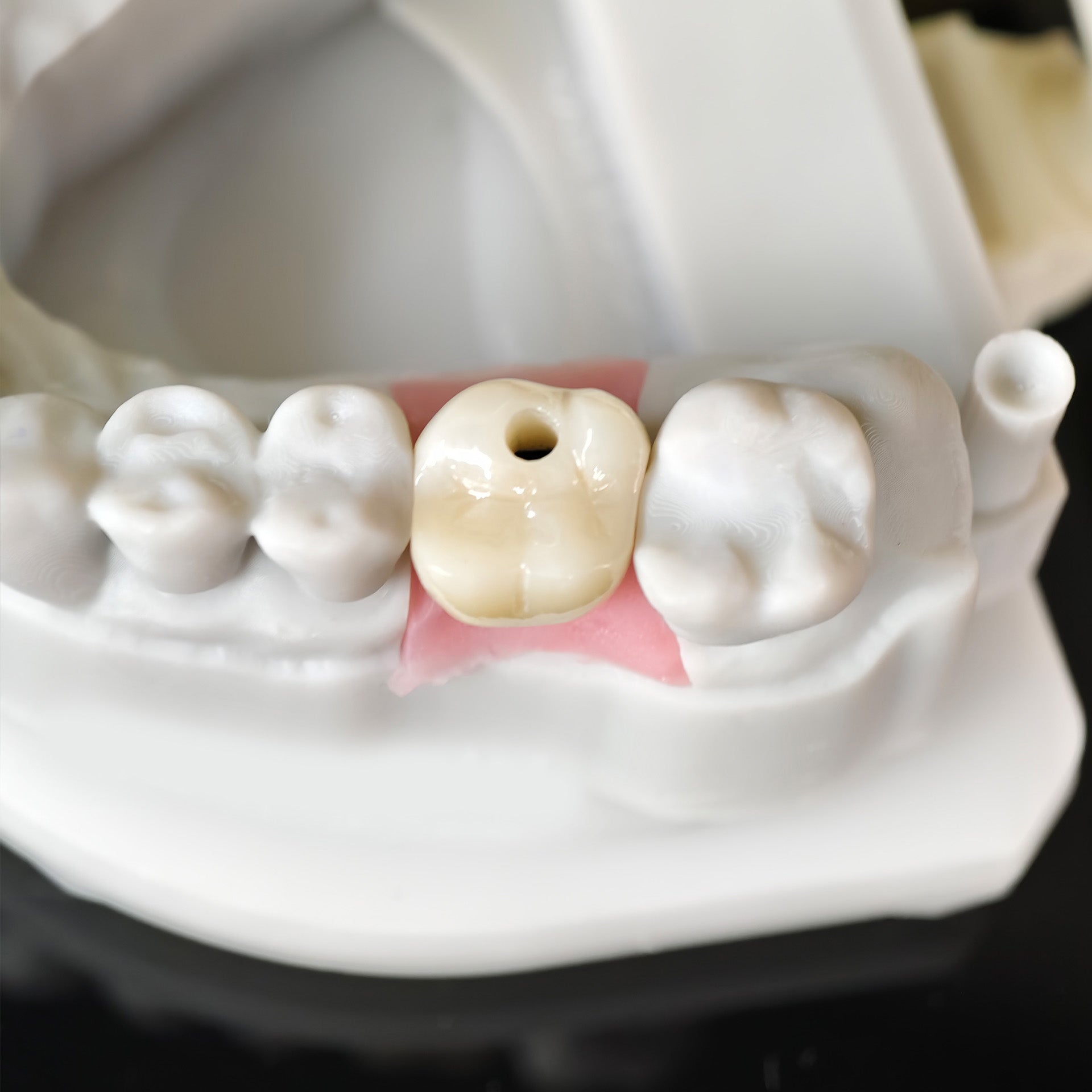 Zirconia Crown With Screw Retained