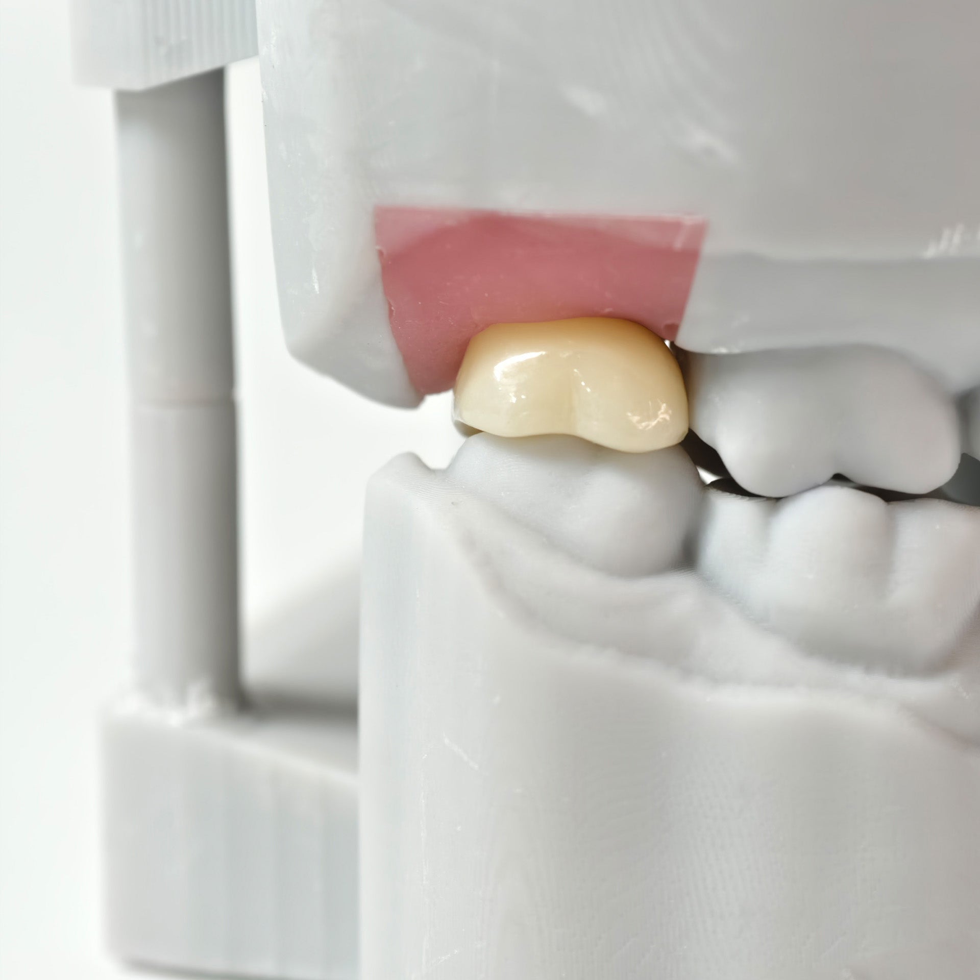 Zirconia Crown With Screw Retained