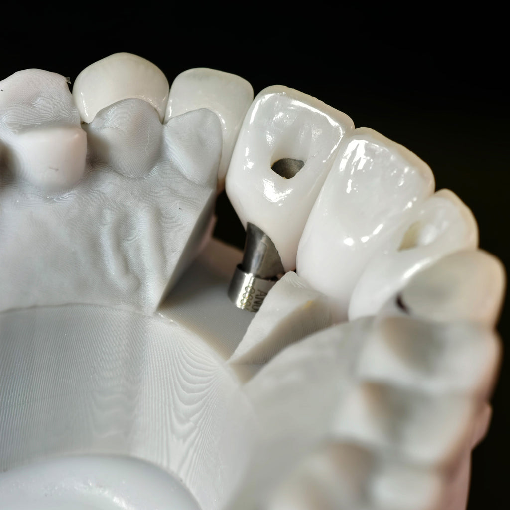 Zirconia Crown With Screw Retained And Cement Retained And Ceramic Veneers