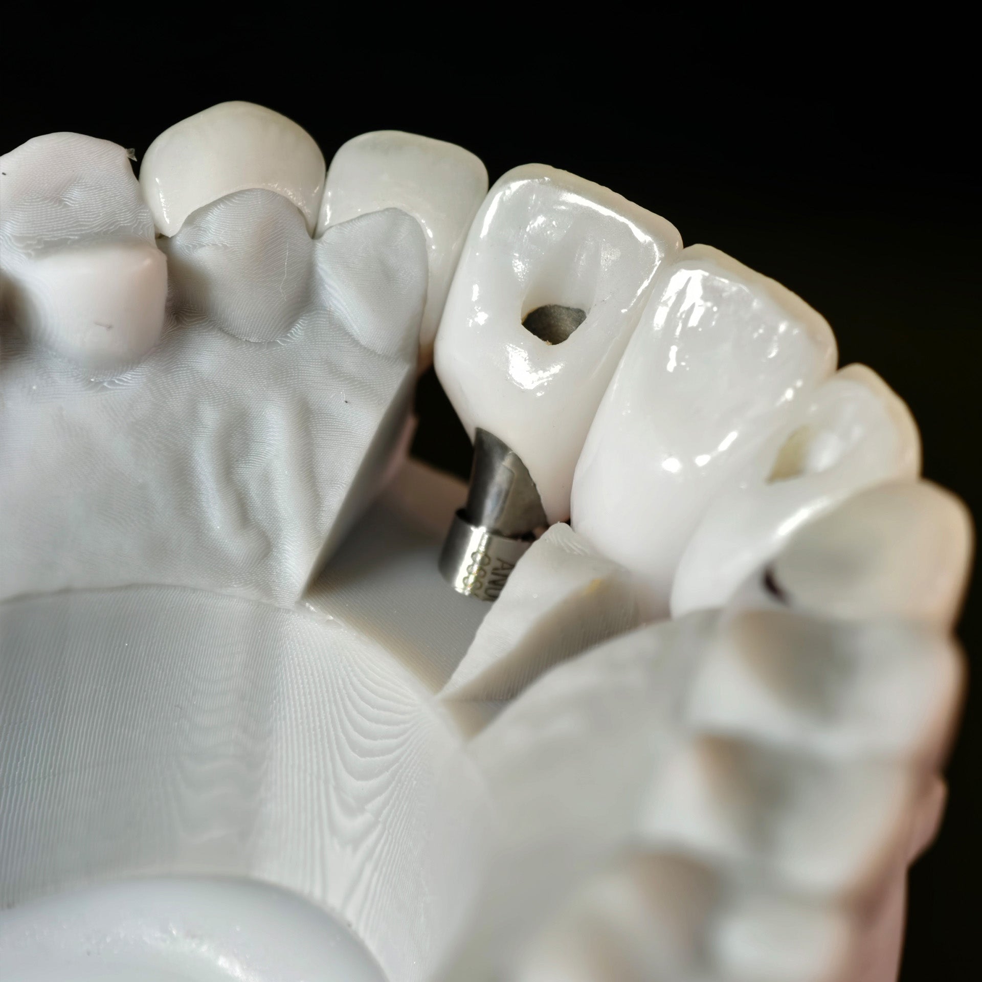 Zirconia Crown With Screw Retained And Cement Retained And Ceramic Veneers