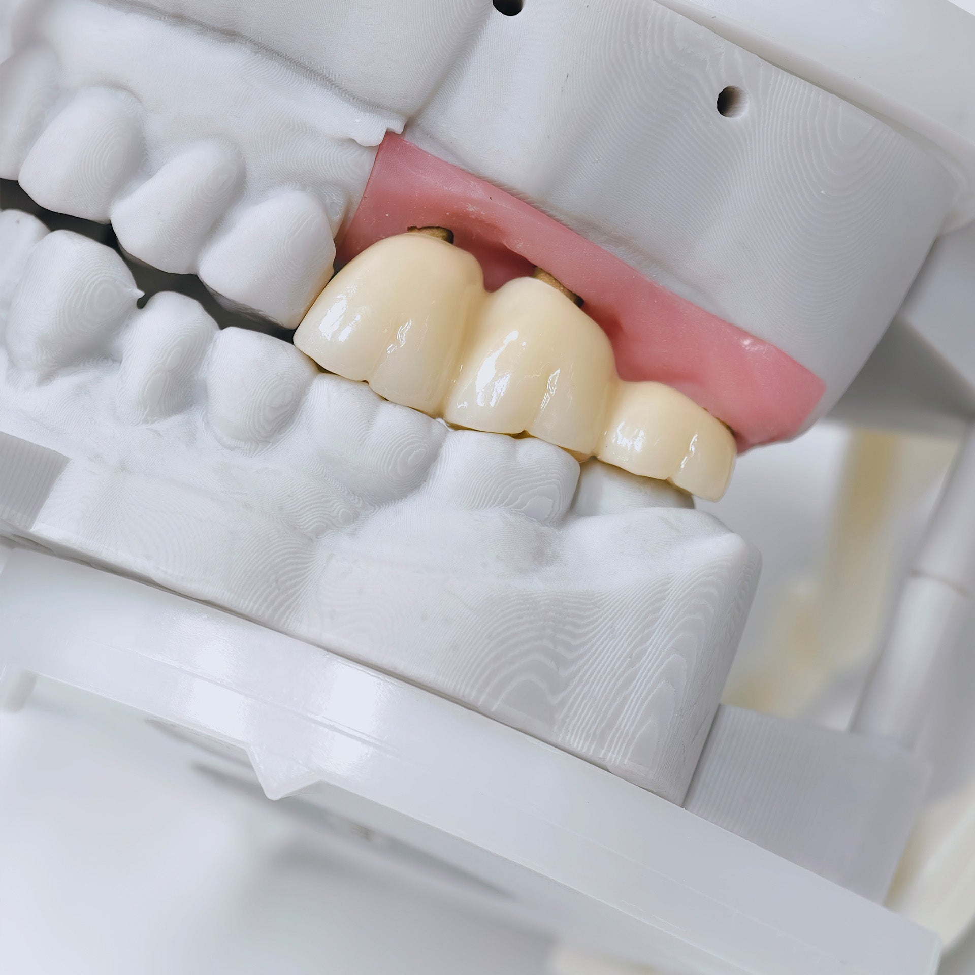 Zirconia Implant Bridge Screwmentable Dental Crown