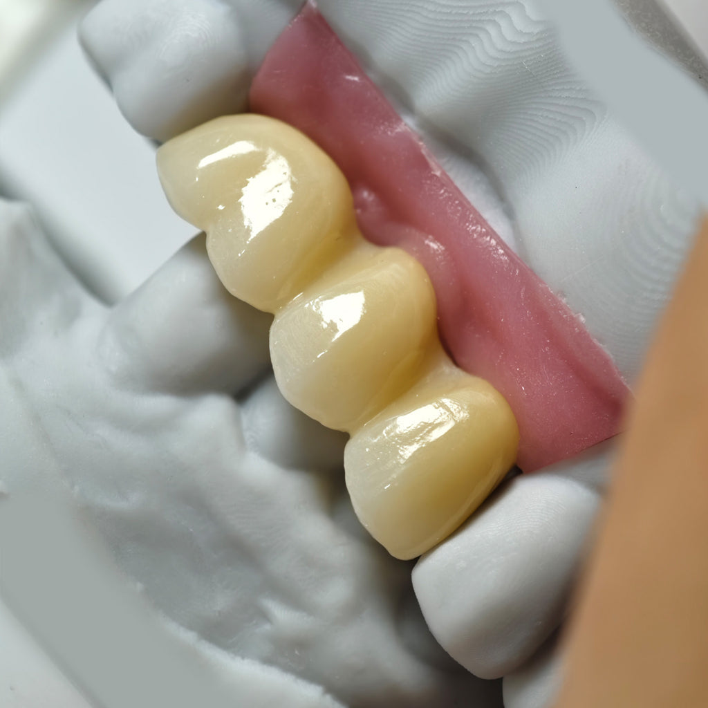 Zirconia Implant Bridge Screwmentable Dental Crown