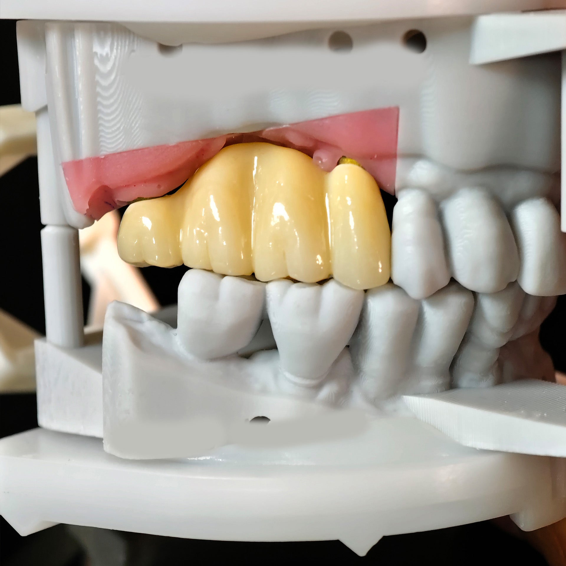 Zirconia Implant Bridge Screwmentable Dental Crown