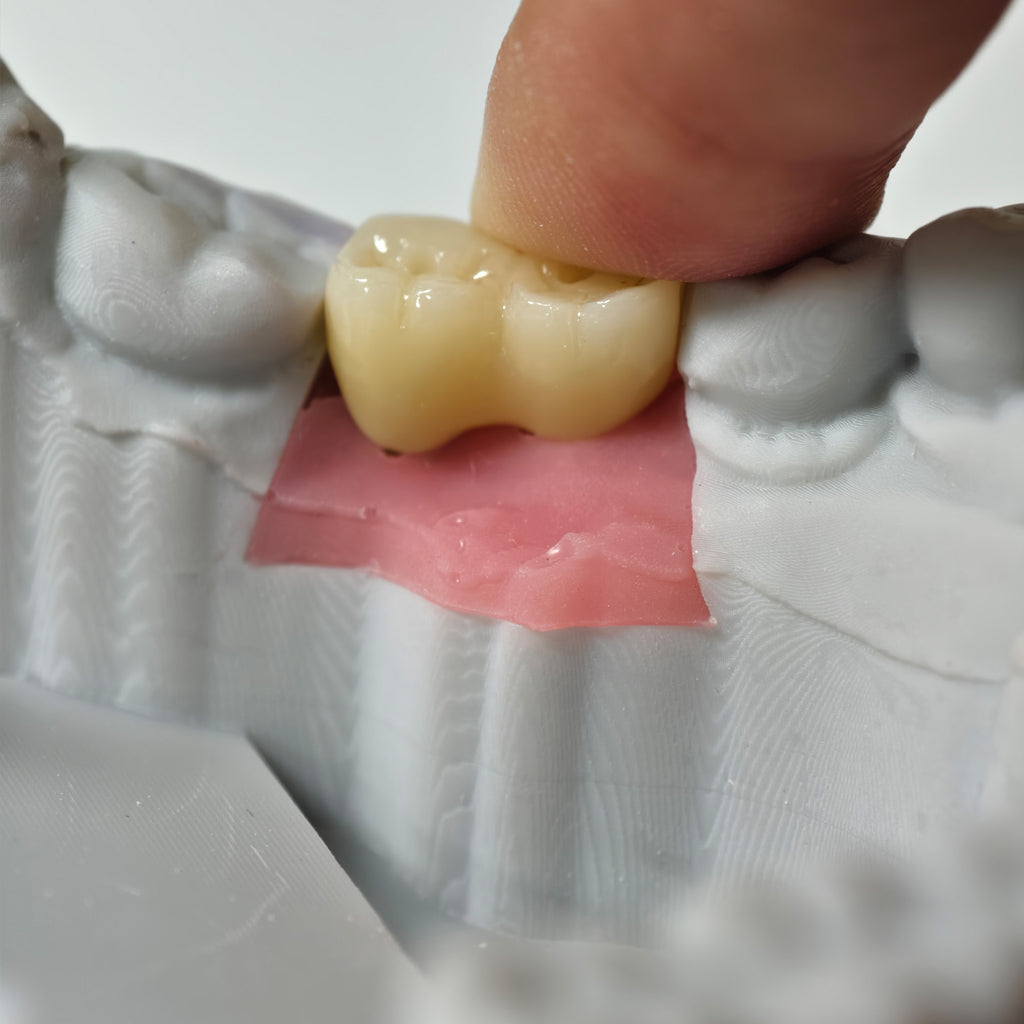 Zirconia Implant Bridge Screwmentable Dental Crown