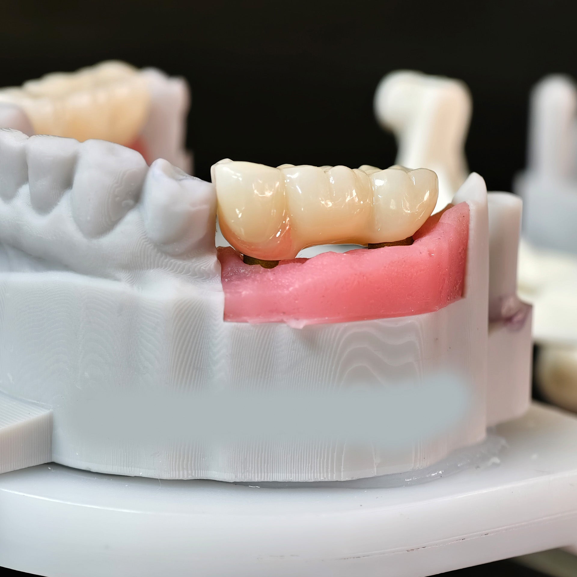 Zirconia Implant Bridge Screwmentable Dental Crown