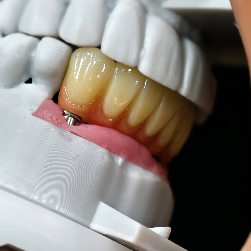 Zirconia Implant Bridge Screwmentable Dental Crown