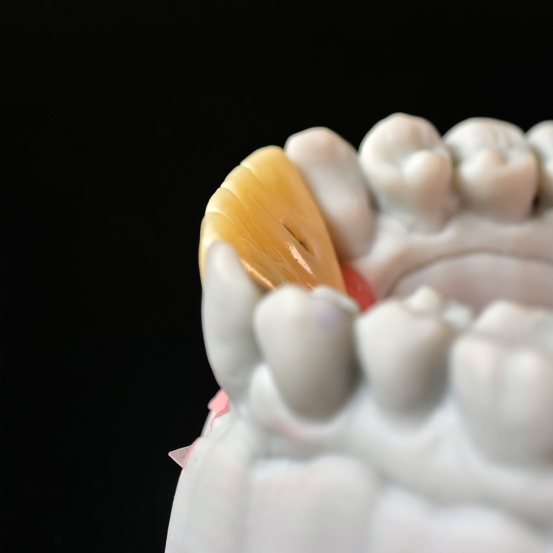 Zirconia Implant Bridge With Gold Plating