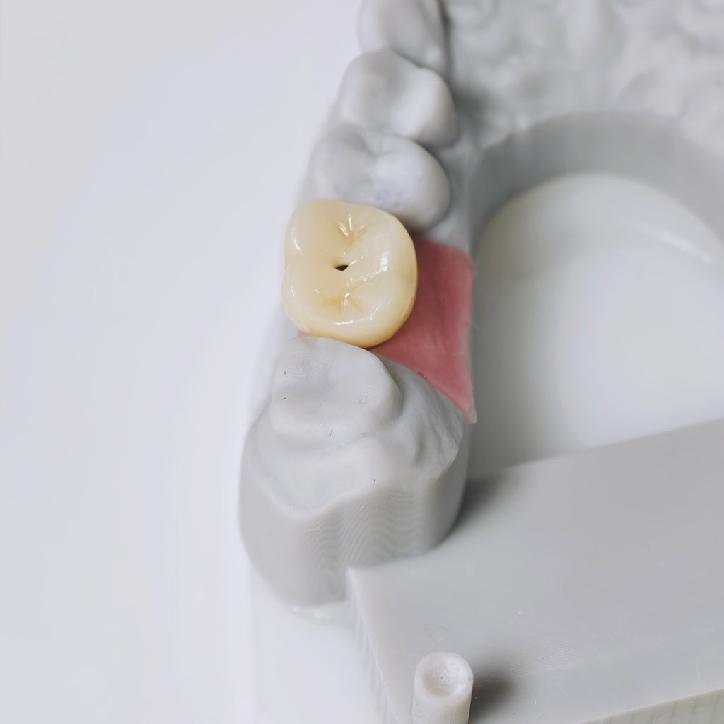 Zirconia Implant Crown Screwmentable Dental Crown