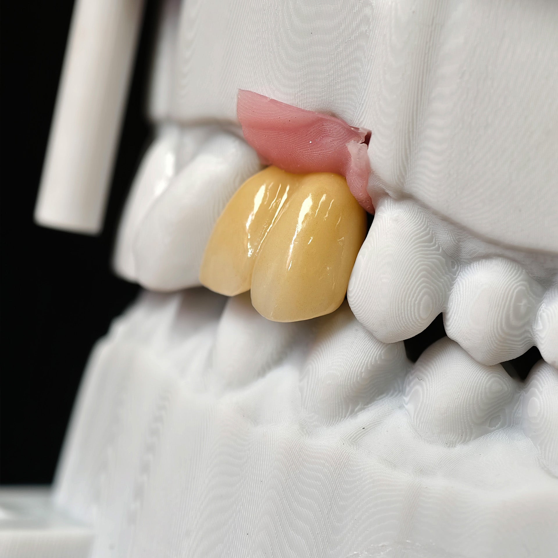 Zirconia Implant Crown With Gold Plating