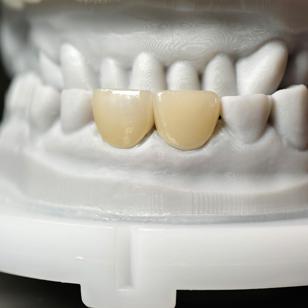 Zirconia Veneer. High Transparency/Translucent, Natural Shade