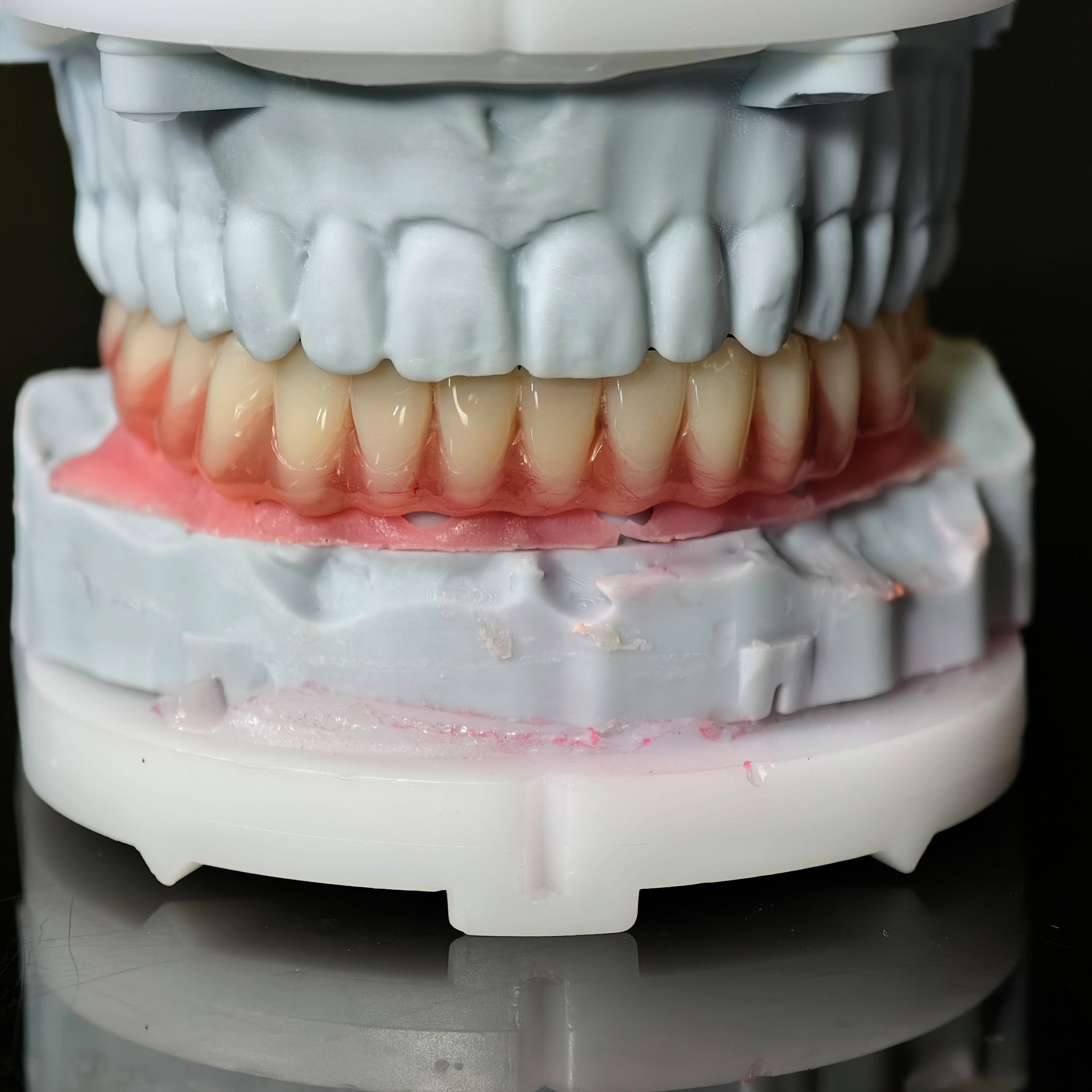 Acrylic Denture With Screw Retained