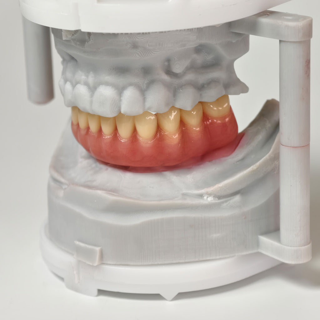 Acrylic Denture With Ti-Bar And Screw Retained