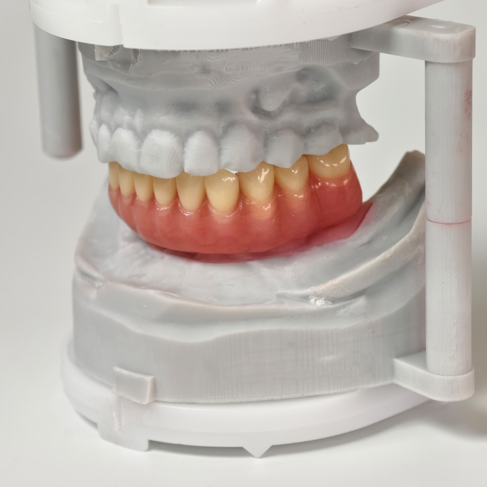 Acrylic Denture With Ti-Bar And Screw Retained