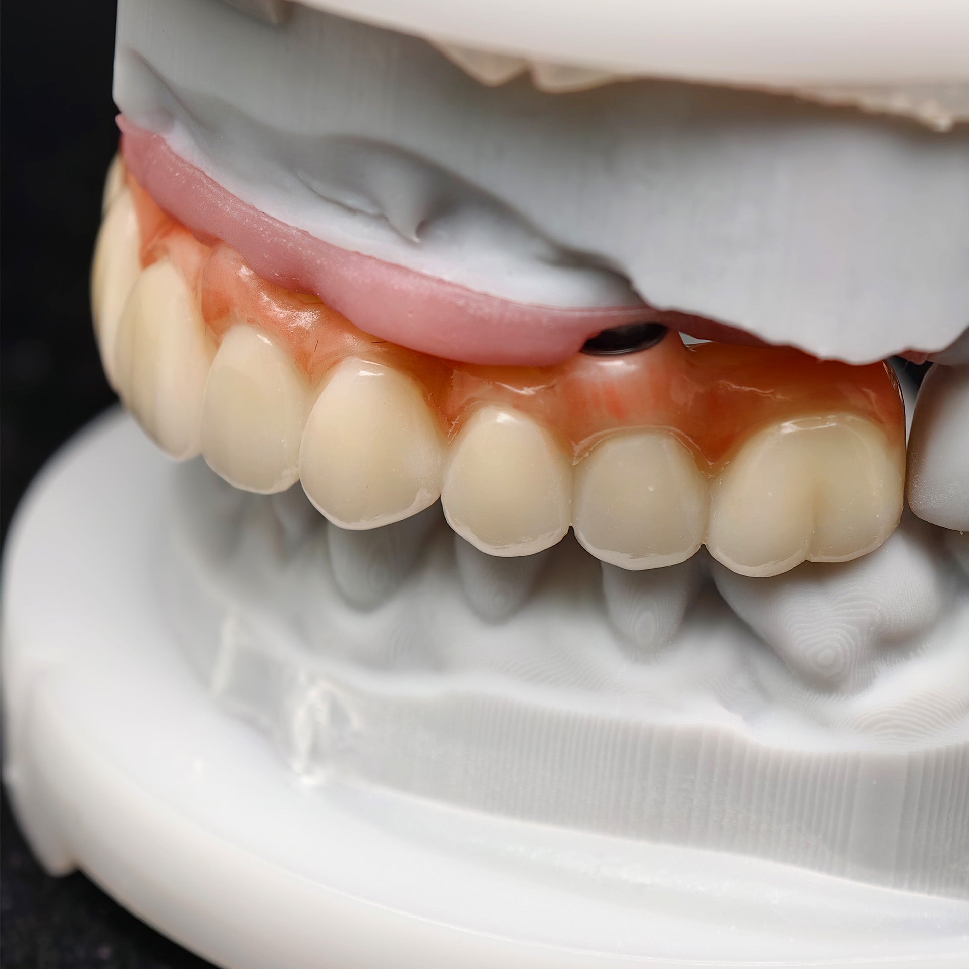 All On 4 Zirconia Bridge With Ti-Base Screw Retained Trying For Full Arch Restoration