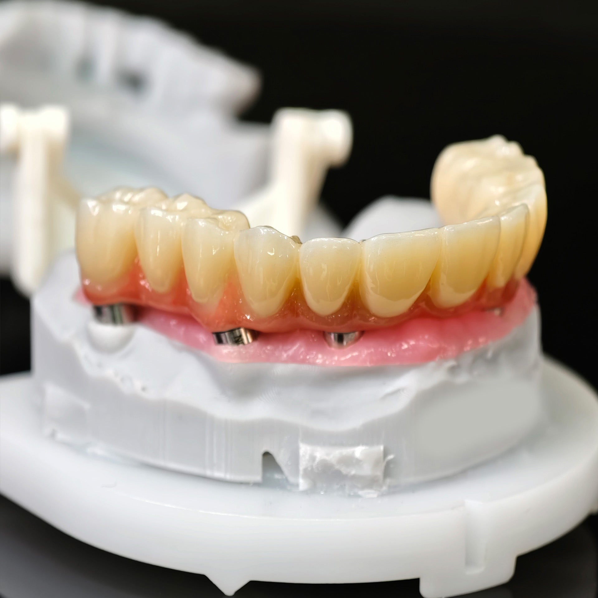 All On 5 Zirconia Bridge With Ti-Base Screw Retained Trying For Full Arch Restoration