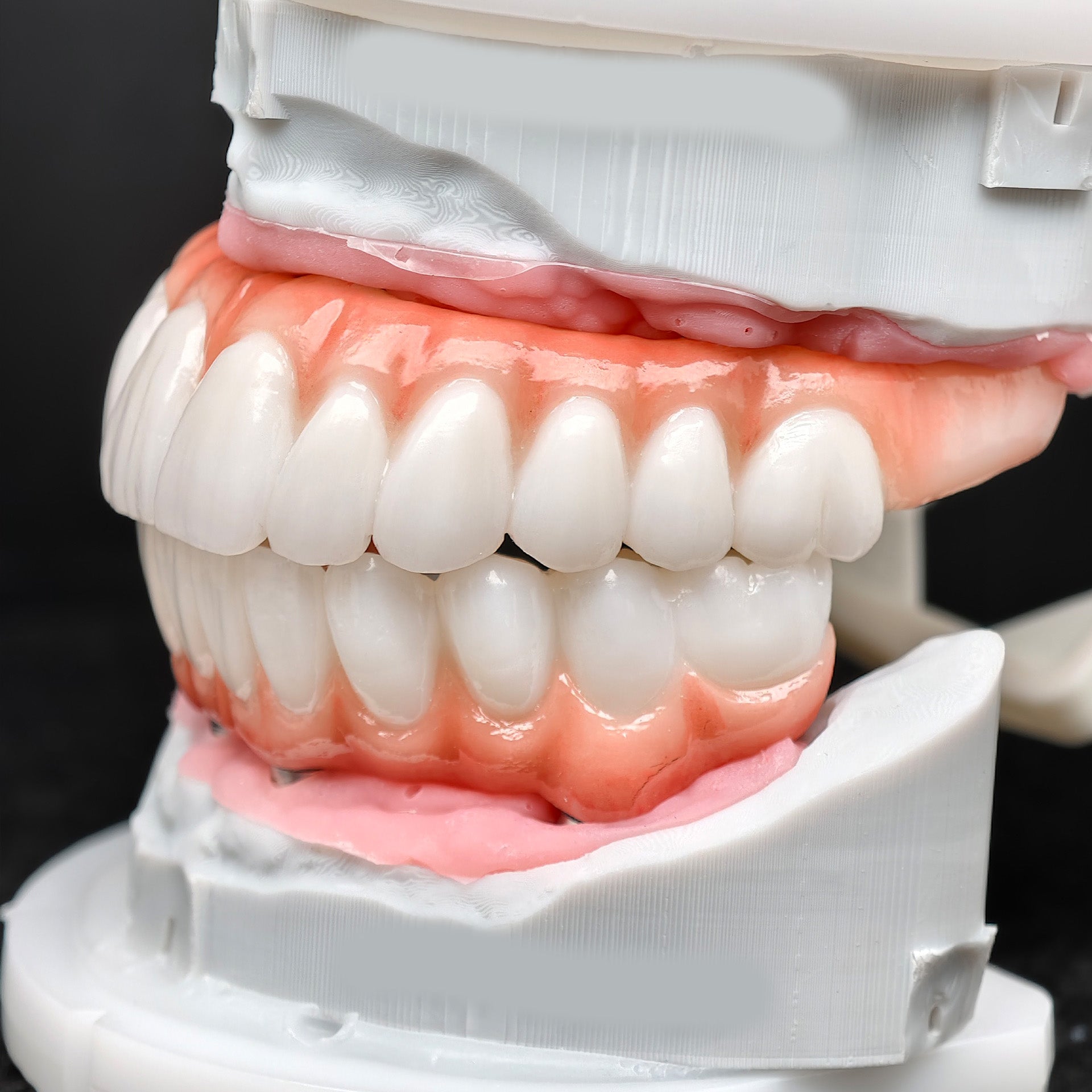 All On 5 Zirconia Bridge With Ti-Base Screw Retained Trying For Full Arch Restoration