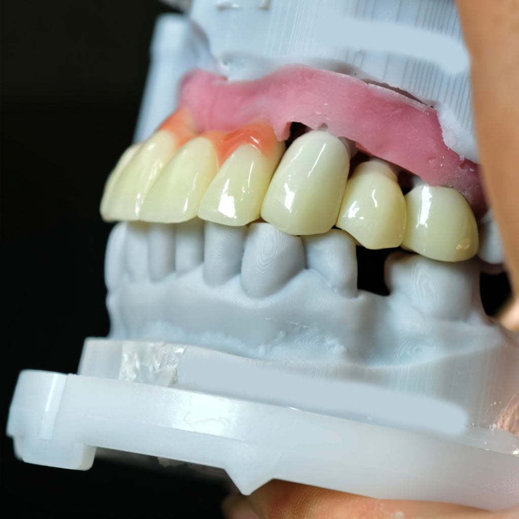 Custom Abutment And PMMA Bridge And Crown With Cement Retained