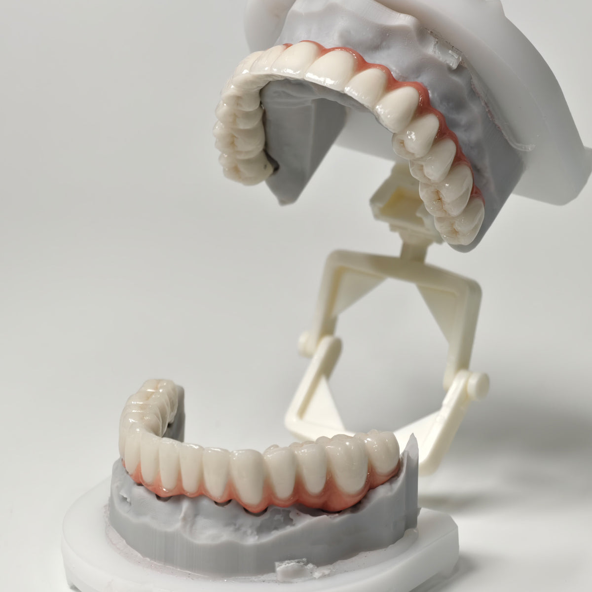 Full-Arch PFM Bridge With Screw Retained