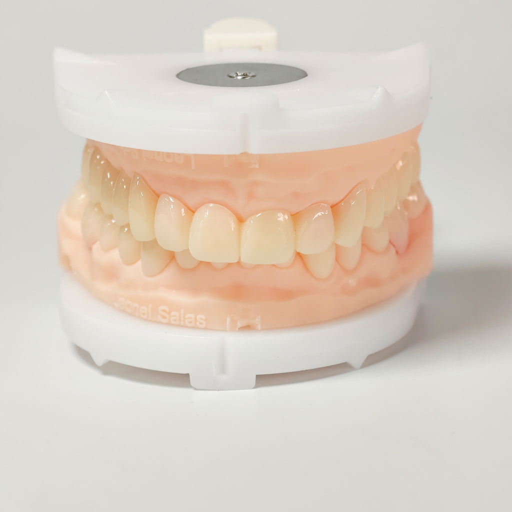 Full-Mouth Segmented PMMA Bridge With Cement Retained