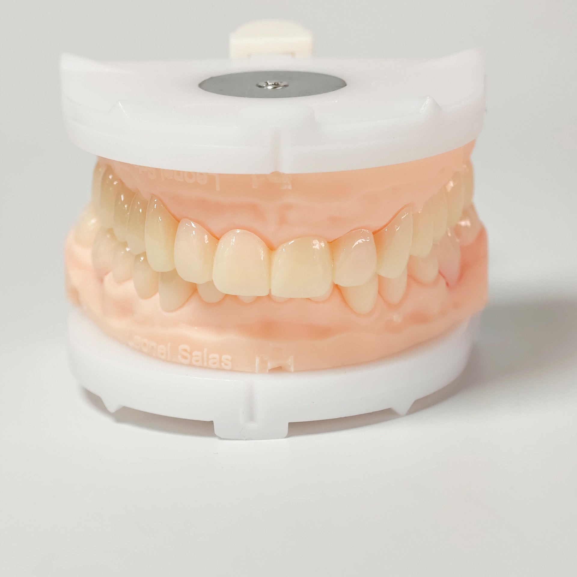 Full-Mouth Segmented PMMA Bridge With Cement Retained