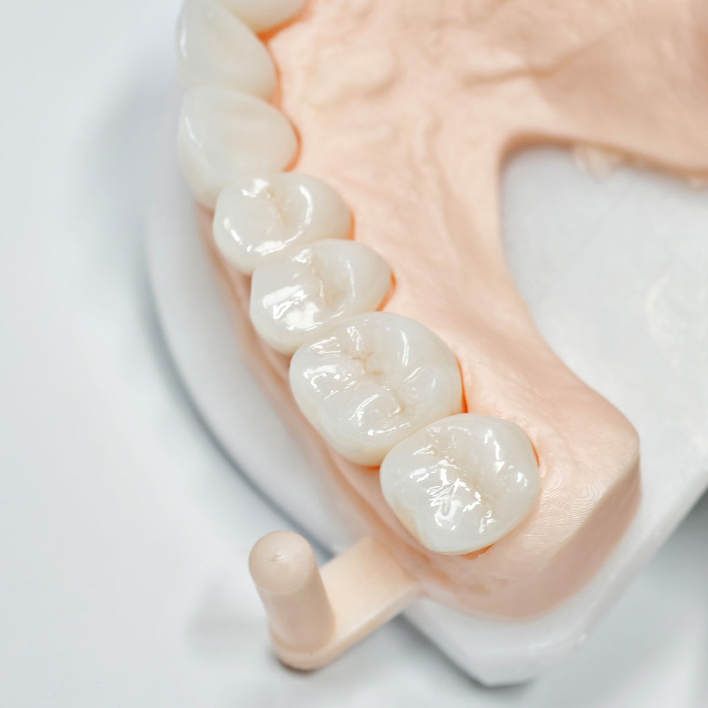 Full-Zriconia Crowns With Cement-Retained
