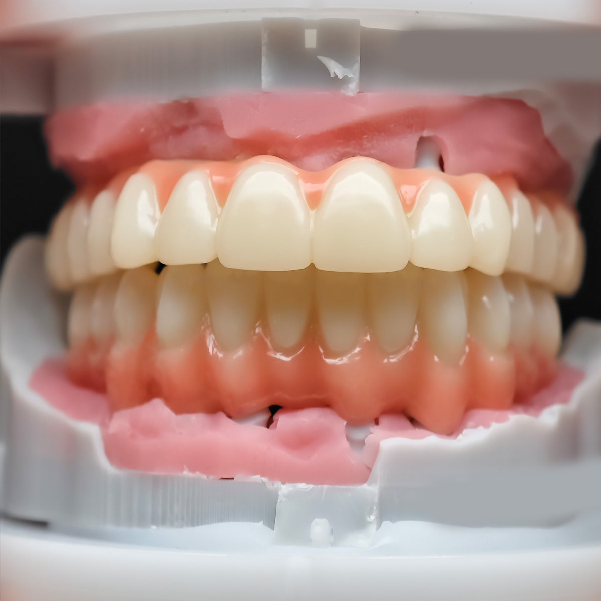 Pmma Bridge And Zirconia Bridge With Cemented