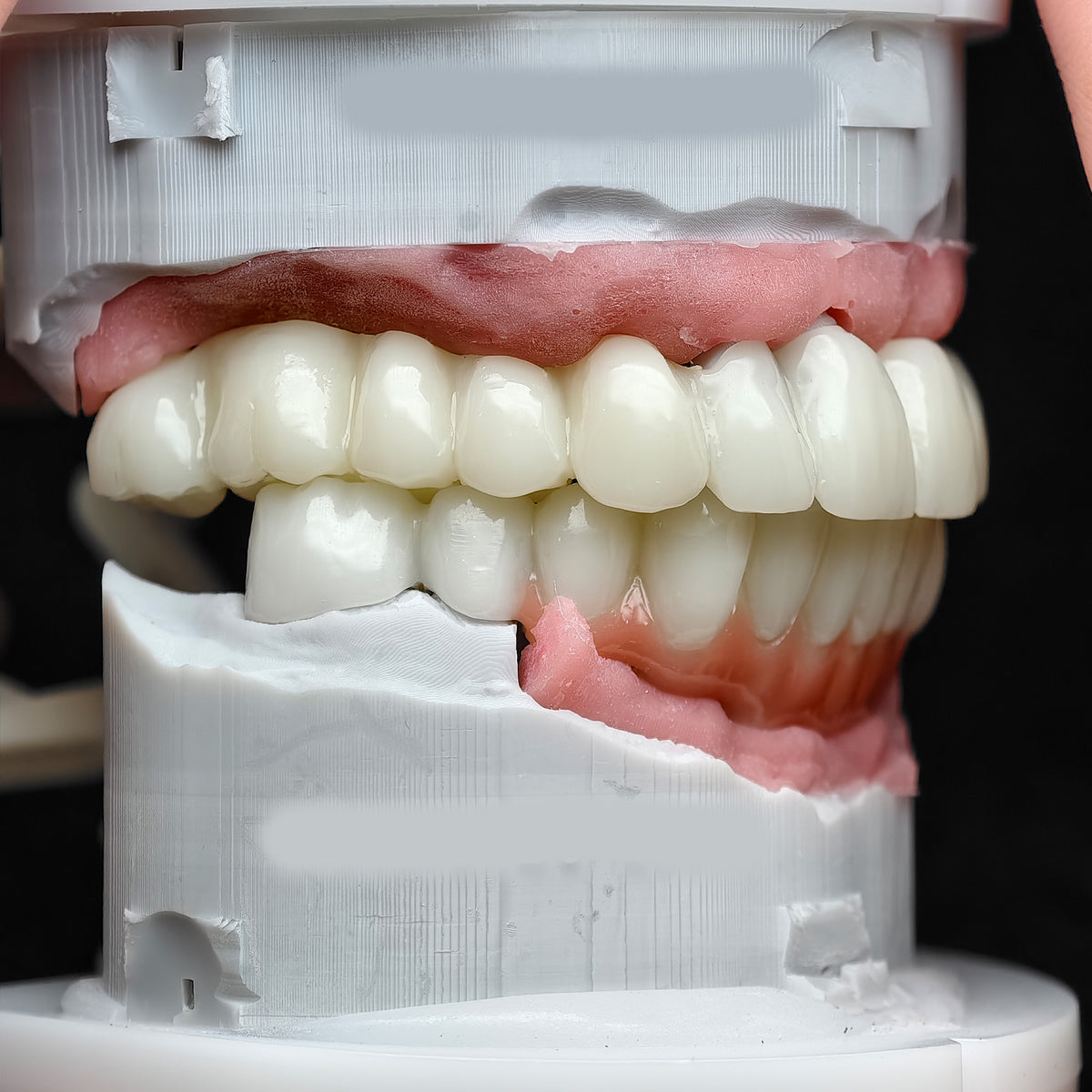 Pmma Bridge With Implant Seating Guide And Cemented