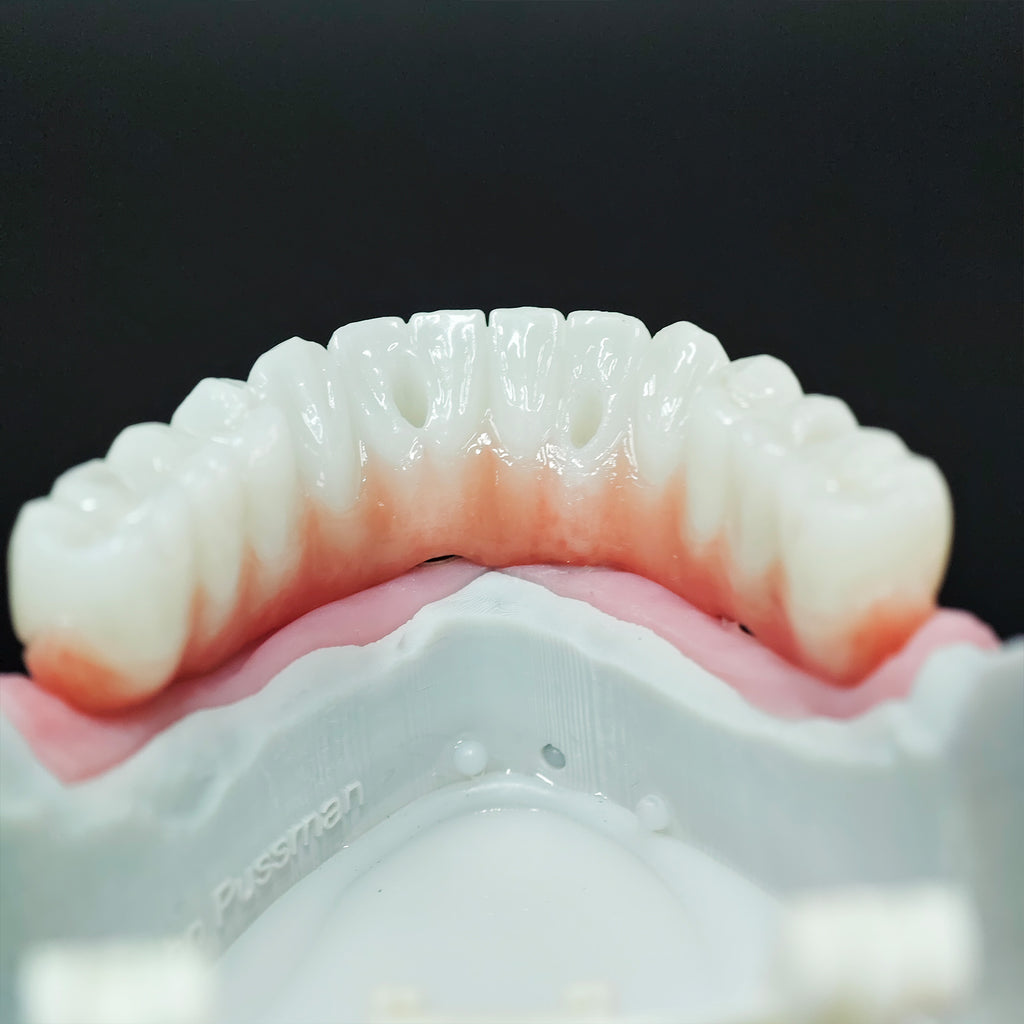 Zirconia Bridge With Ti-Base Abutment