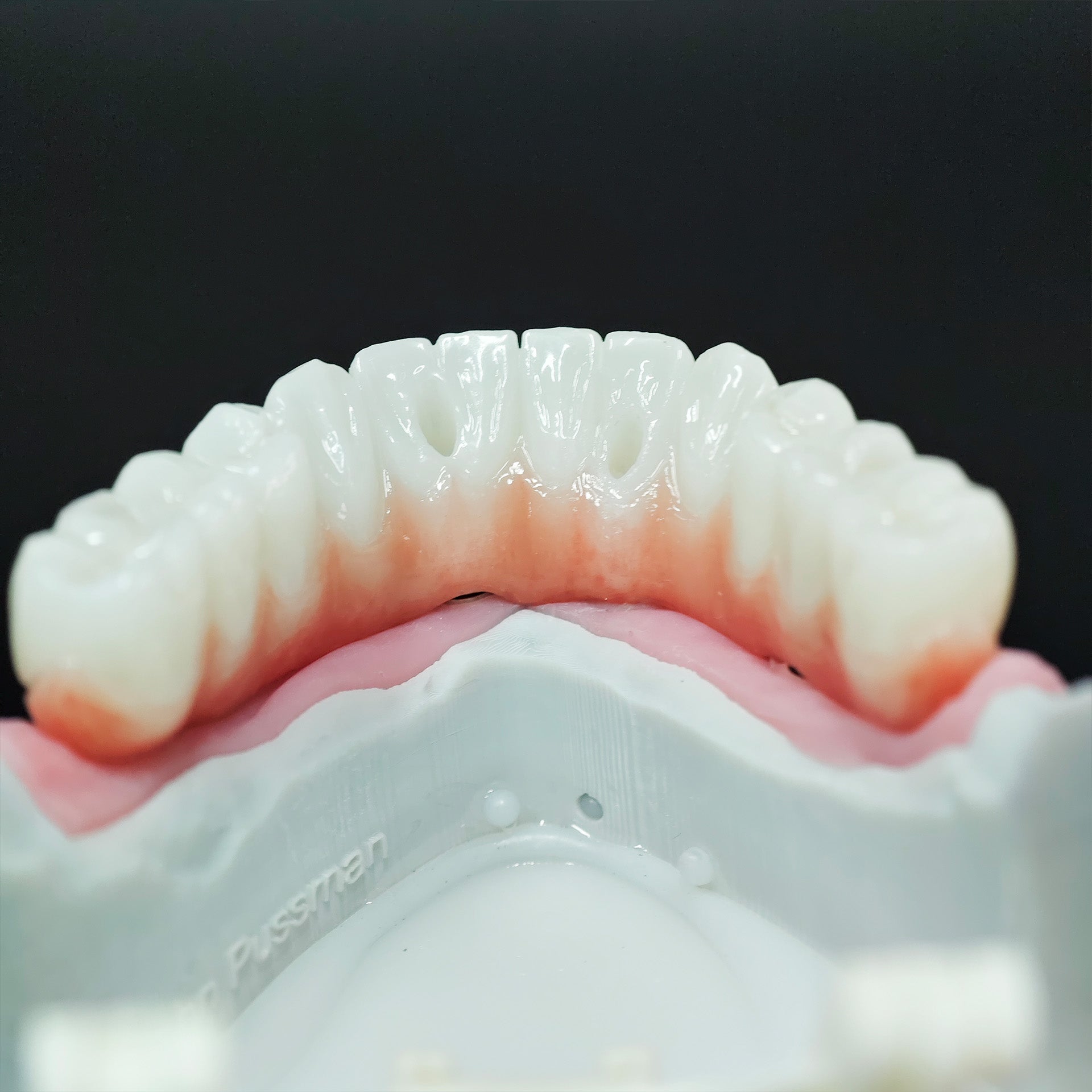 Zirconia Bridge With Ti-Base Abutment