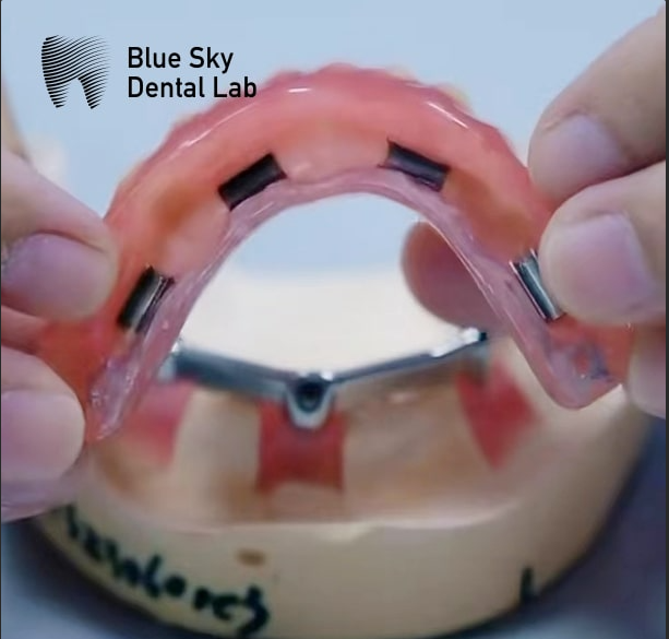 An Overdenture Supported By Dental Implants More Cost-Effective