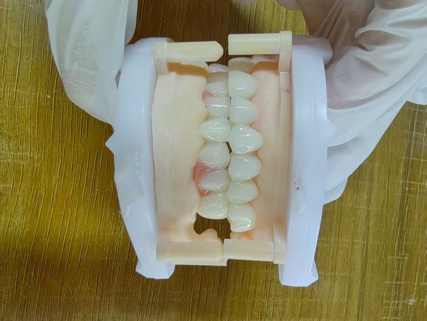 PMMA Bridge After We Received The Surgical Implant Plan Leave Holes Immediate Temporary Teeth