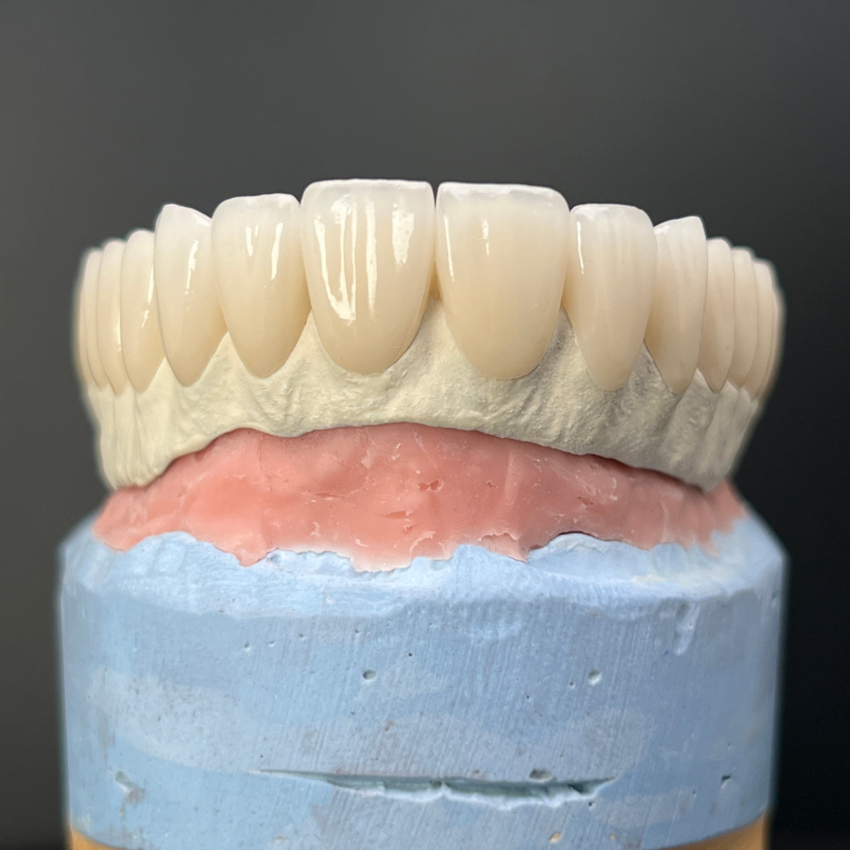 Malo Bridge Implant Restorations