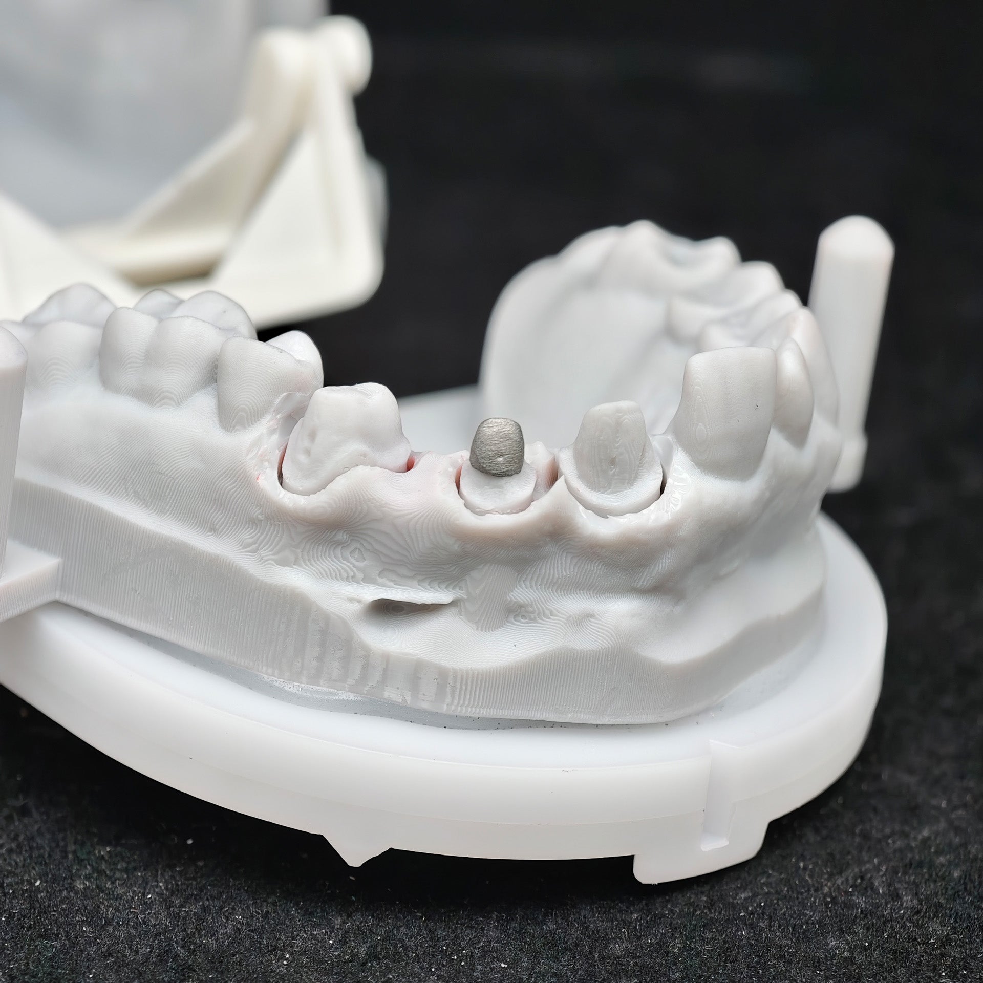 Co - Cr PFM Dental Bridge With Metal Post-And-Core
