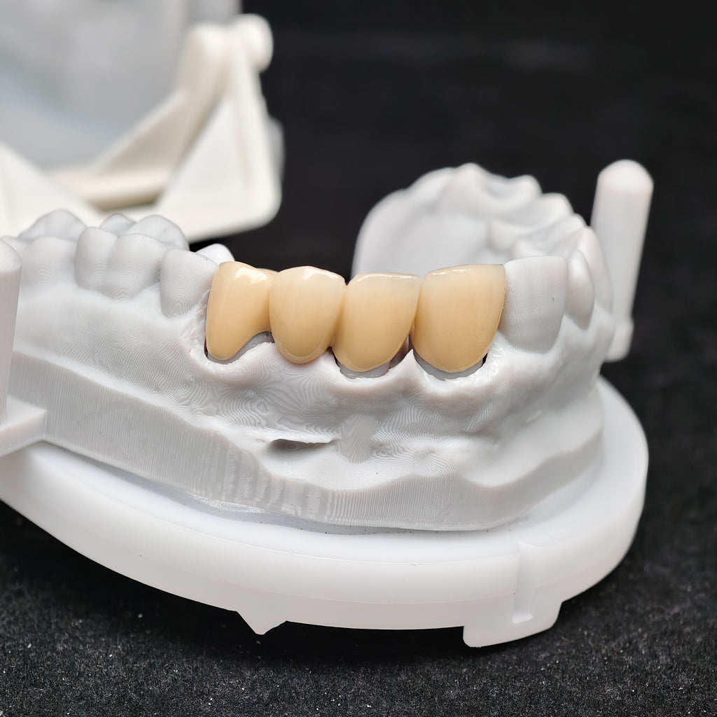 Co - Cr PFM Dental Bridge With Metal Post-And-Core