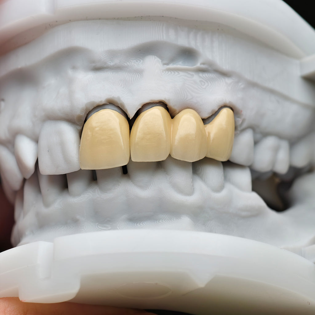Co - Cr PFM Dental Bridge With Metal Post-And-Core